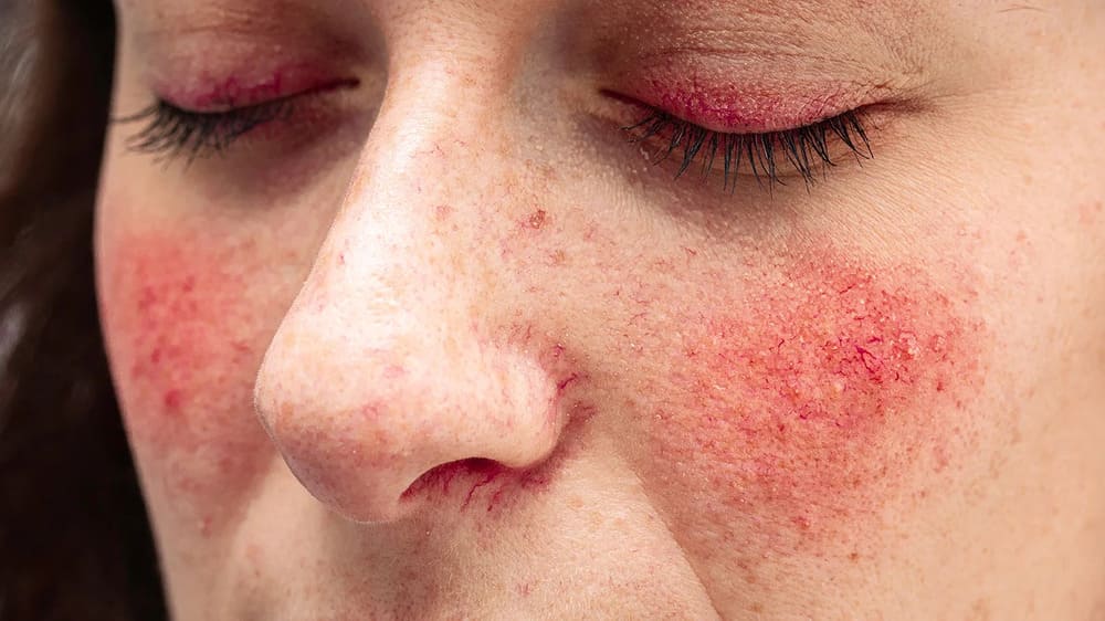 allergy